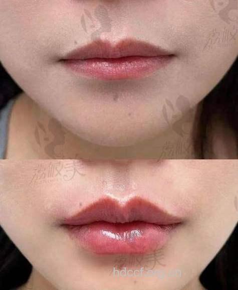 唇珠整形术塑造男人都爱的性感双唇