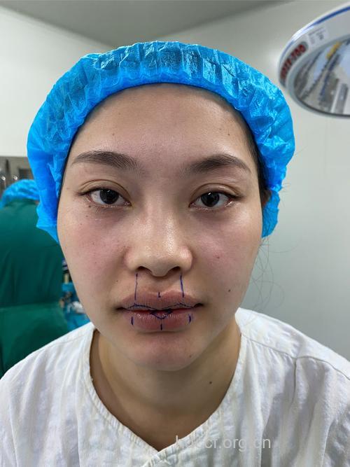 关于唇部整形手术你应该知道的事