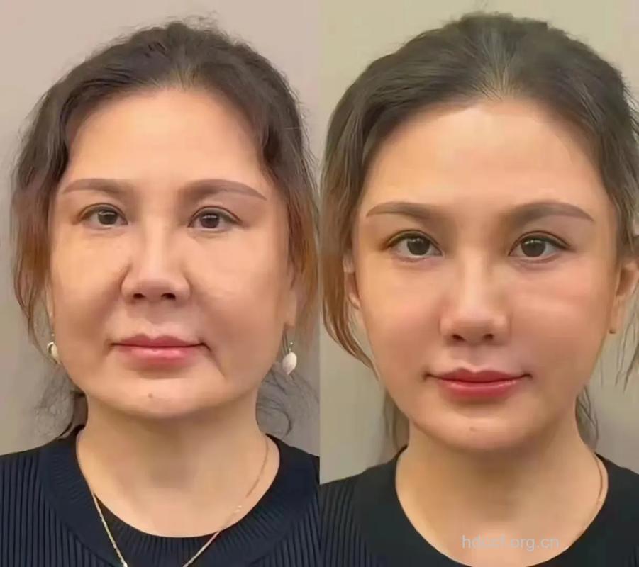 拉皮除皱效果怎么样