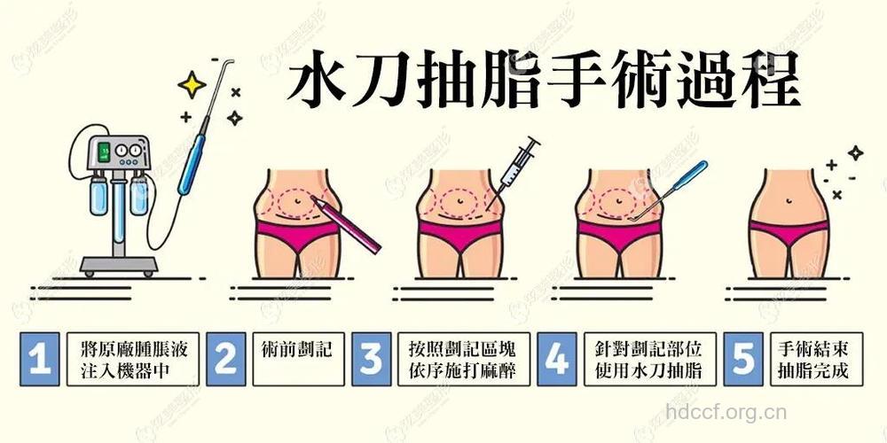 腰部吸脂术的原理