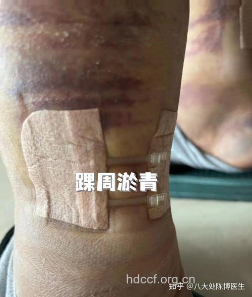 为何吸脂手术后会出现淤血呢？