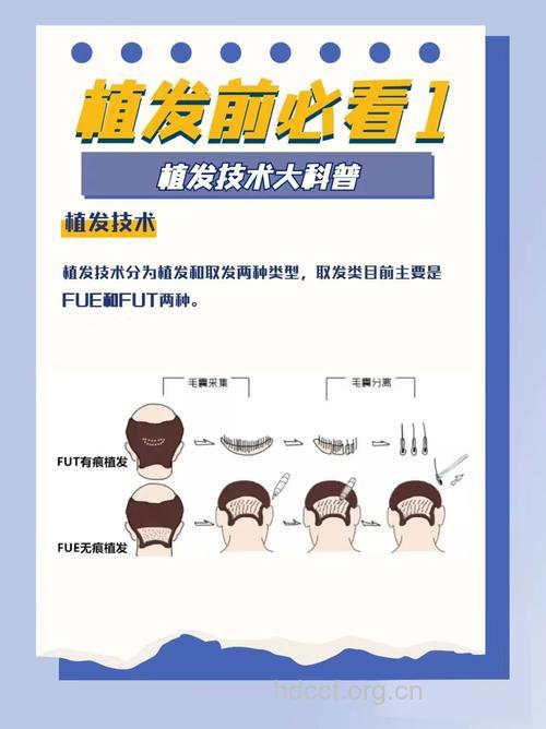 了解毛发移植的常识