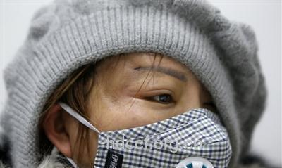 女子吃辣头肿变形 居然是美容针惹的祸