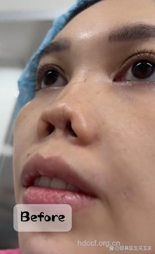 女大学生隆鼻身亡 隆鼻手术这些风险