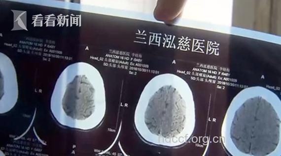 大妈做ct被关1小时 去痘痘不如防痘痘