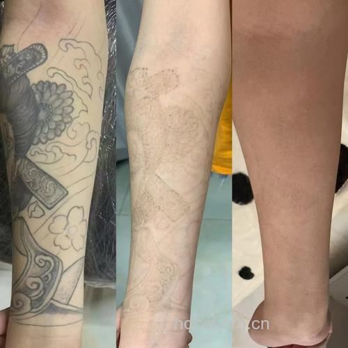 什么是激光洗纹身?
