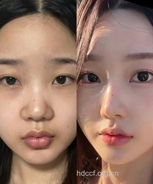 美女整鼻越整越歪 哪些人适合整形