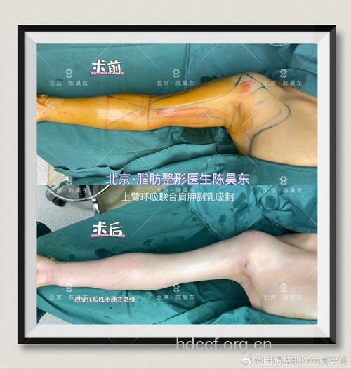 怎么进行手臂吸脂手术方法