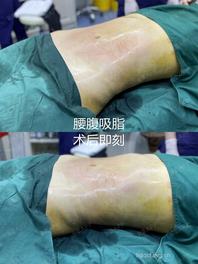 什么是共振吸脂