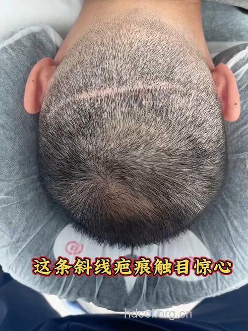 疤痕毛发移植的注意事项