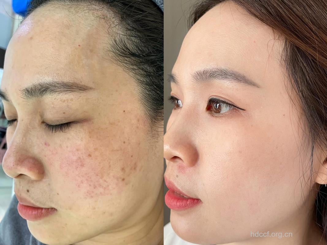 光子嫩肤的去斑效果如何