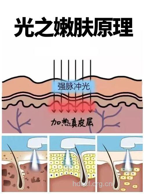 光子嫩肤的原理