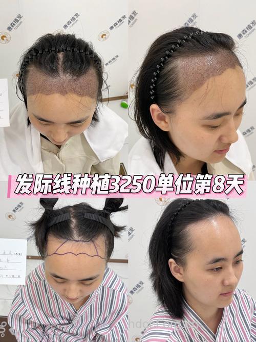 头发种植术安全性多高