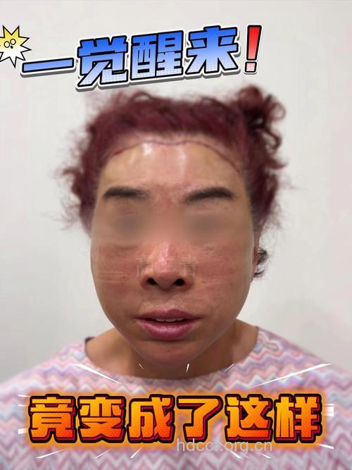 女子美容院拉面皮昏迷命危 面部拉皮有哪些风险