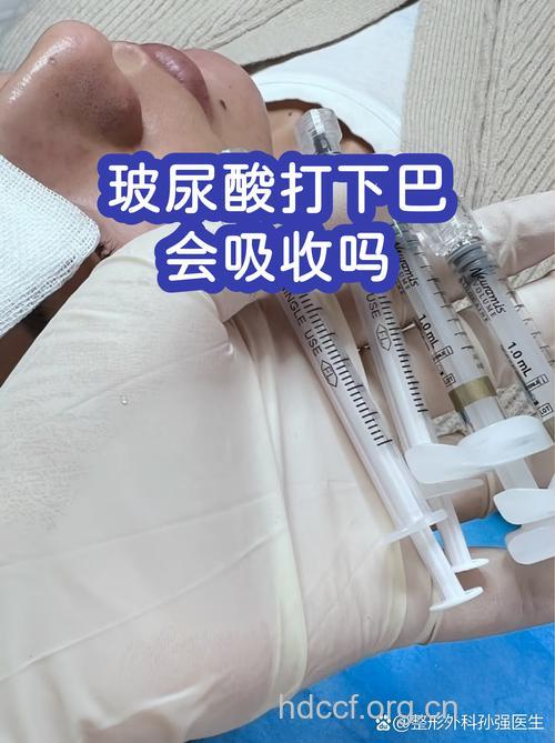 下巴变长丈夫离婚 疑因注射玻尿酸导致