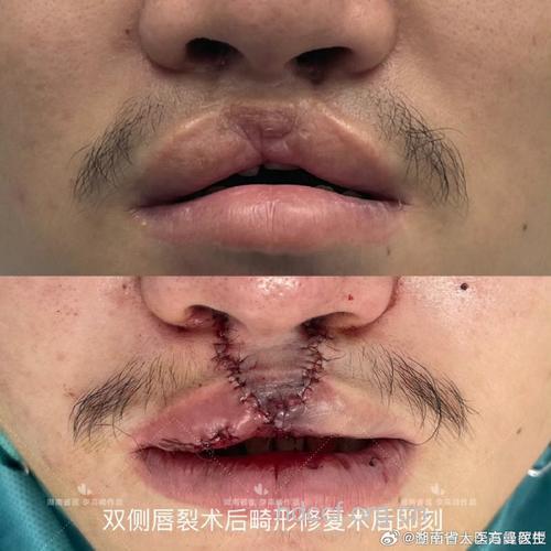 纹唇手术有什么并发症