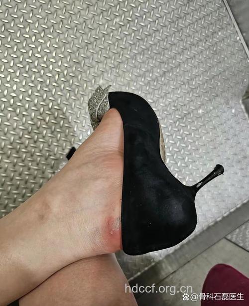 常穿高跟鞋老后易患关节炎