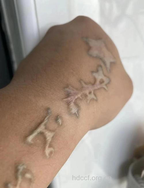 女学生除纹身被坑留疤痕 纹身疤痕如何处理