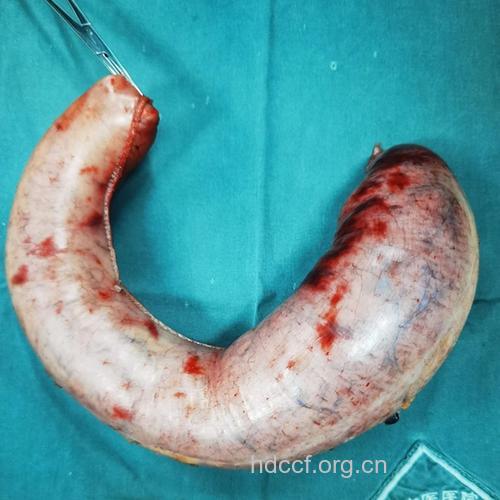 全国首胖减重手术 切掉的胃重达4斤