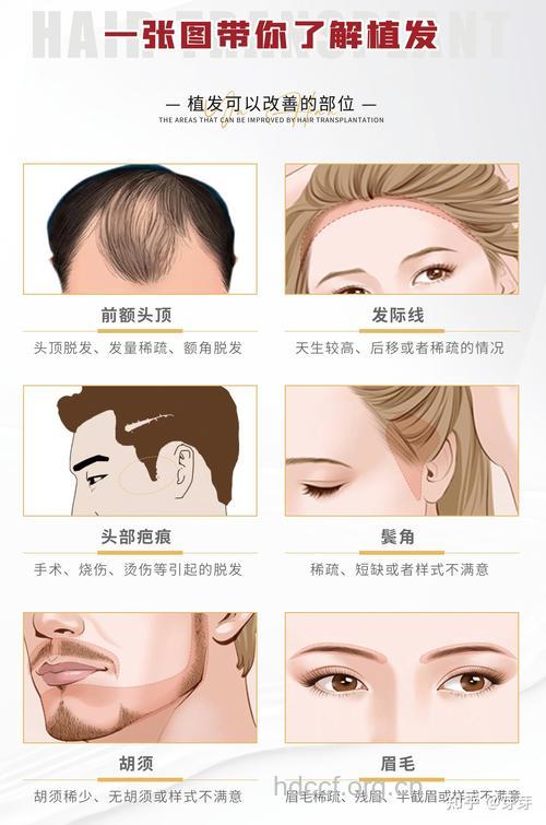 哪些人适宜毛发种植呢
