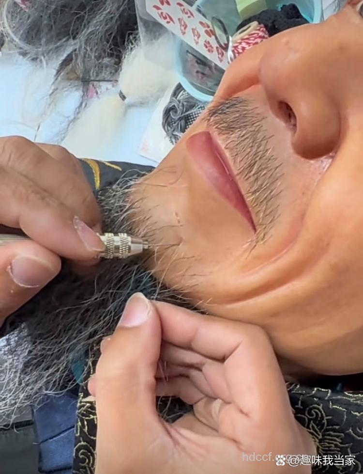 胡须种植做真汉子