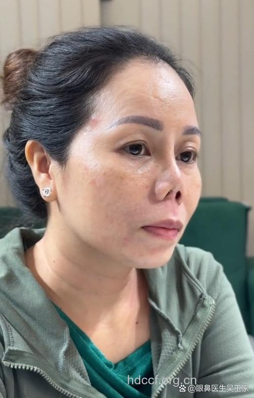 女子隆鼻致失明 揭玻尿酸致失明的原因