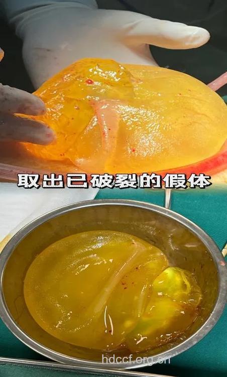 女子隆胸5年假体破裂 揭隆胸的六大危害