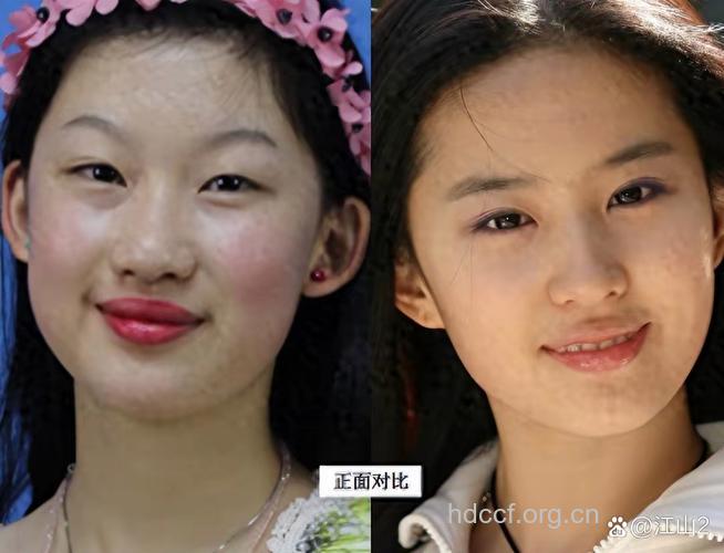 19岁女孩整容记 整成第二个刘亦菲
