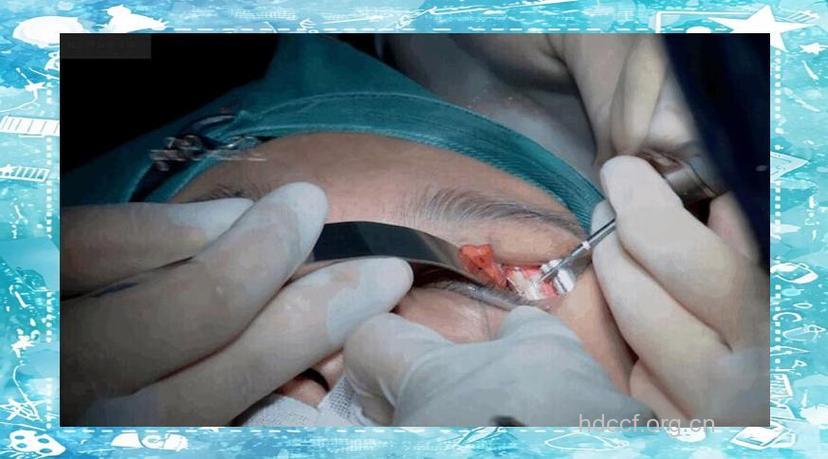 女子修复双眼不对称 二次手术导致泪腺脱垂加重