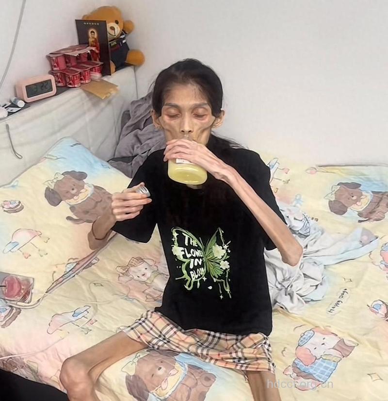 少女减肥仅剩30公斤 节食减肥谨防厌食症