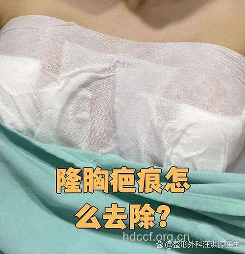 隆胸手术后忘拆线伤口腥臭 隆胸后胸掉到肚子