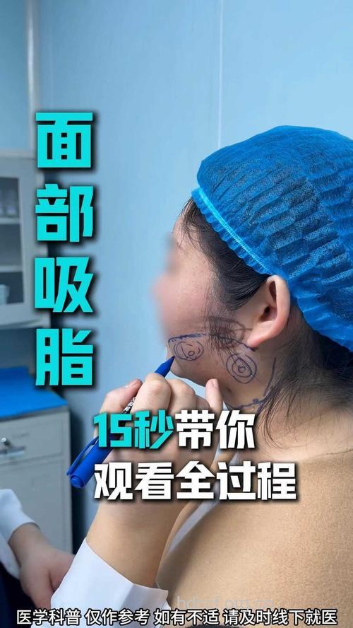 盘点面颊部抽脂整形过程