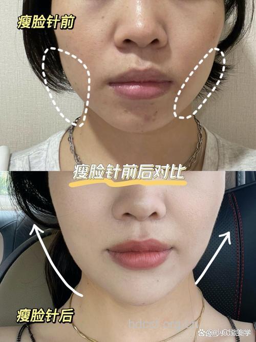 快速变身小瘦脸,注射瘦脸针的效果好吗