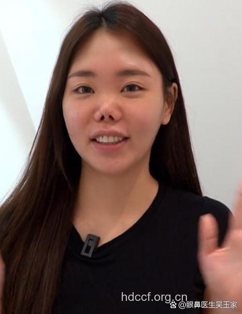 女子鼻梁能游走 整形须慎重