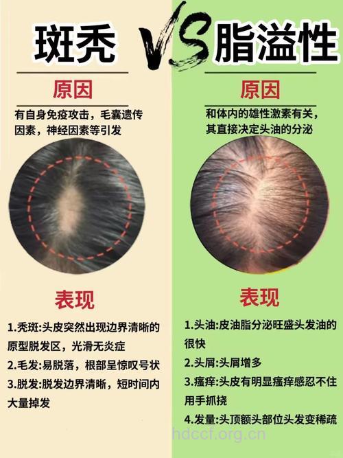 西医治疗斑秃的基本方法