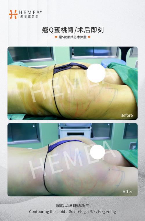 医生用水泥为人隆臀 水泥也能隆臀吗