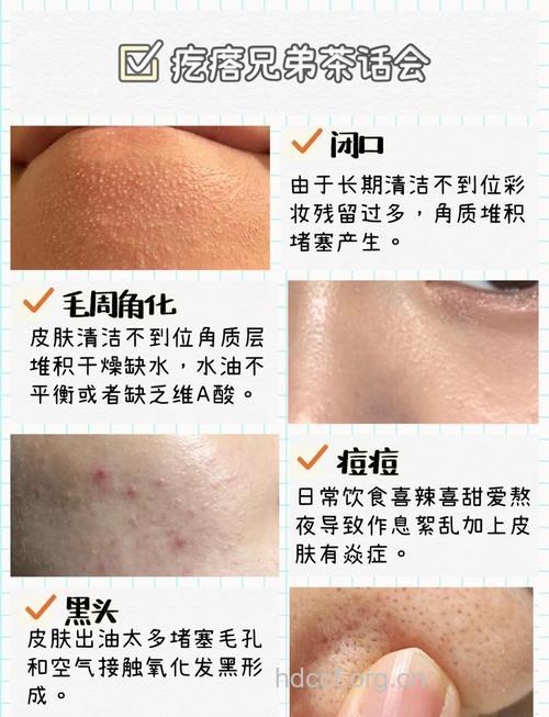 怎么让痘痘全部清光光