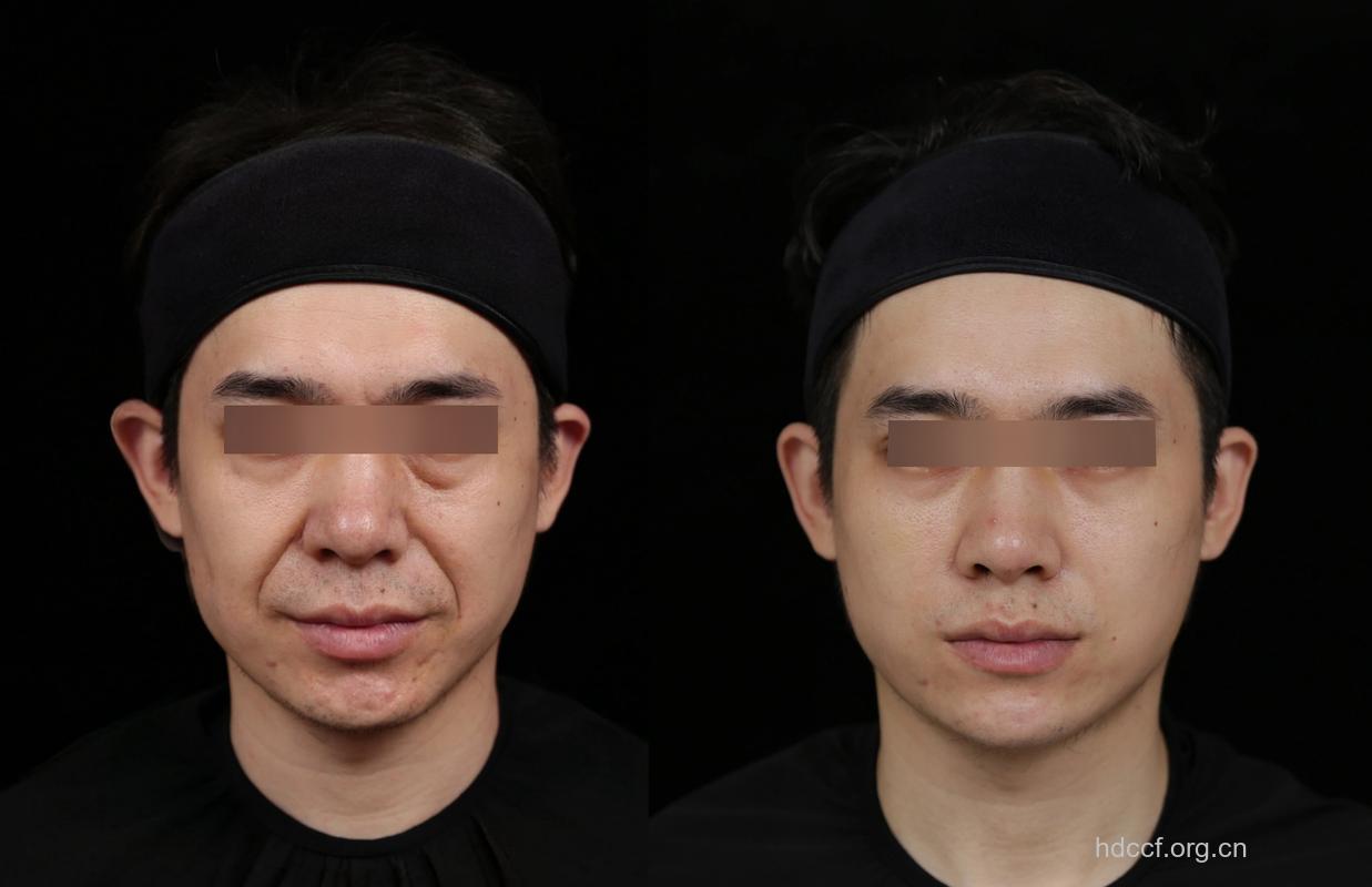 男人额头皱纹可尝试电波拉皮