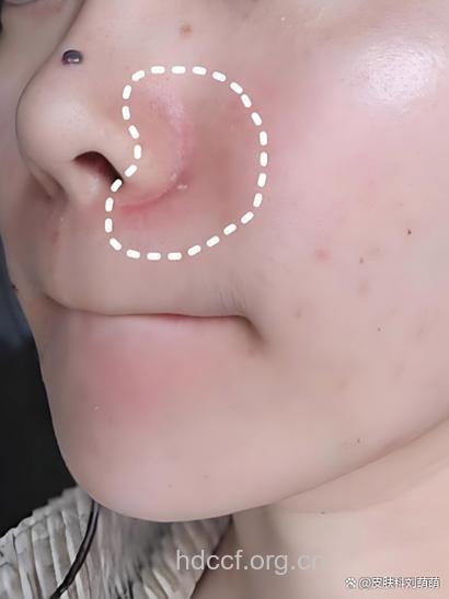 美丽的陷阱：女子鼻部皮肤变薄