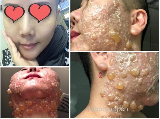 电波拉皮失败的可怕经历