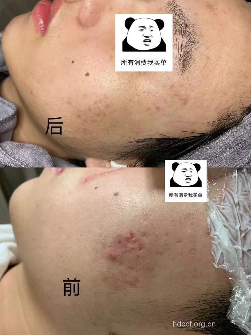 怎么摆脱“月球脸”
