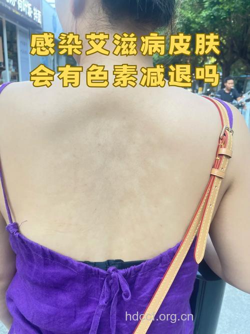 身体酸碱度影响斑点