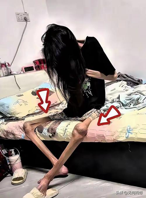 3年瘦成60斤白骨精 过度减肥易得厌食症