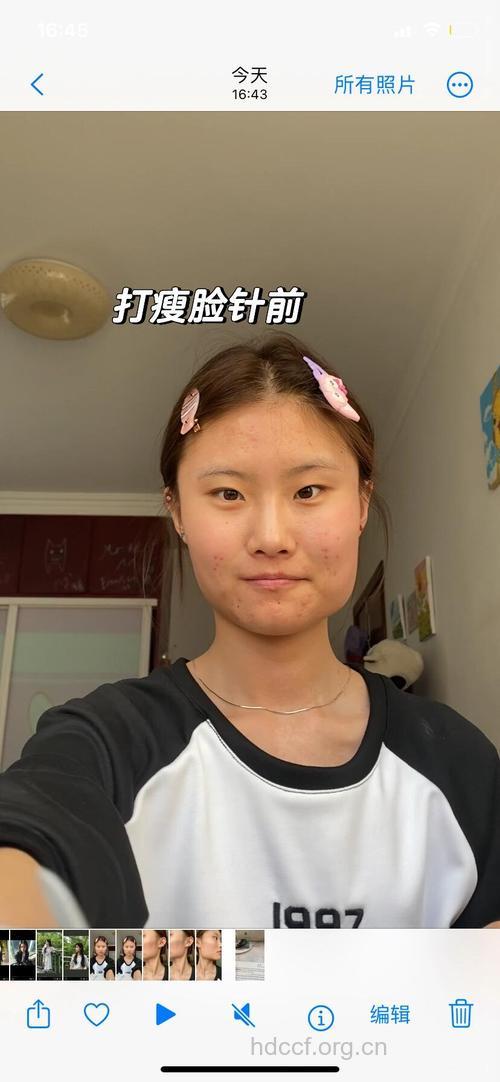 网友暴详细瘦脸针手术过程