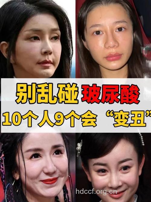 注射整形明星都打玻尿酸