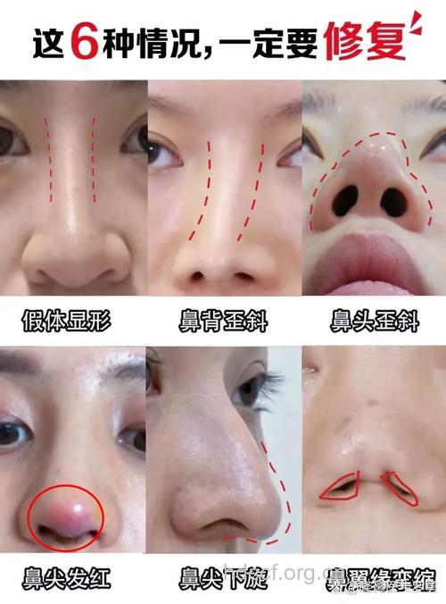 鼻综合整形火了 这些问题别忽视