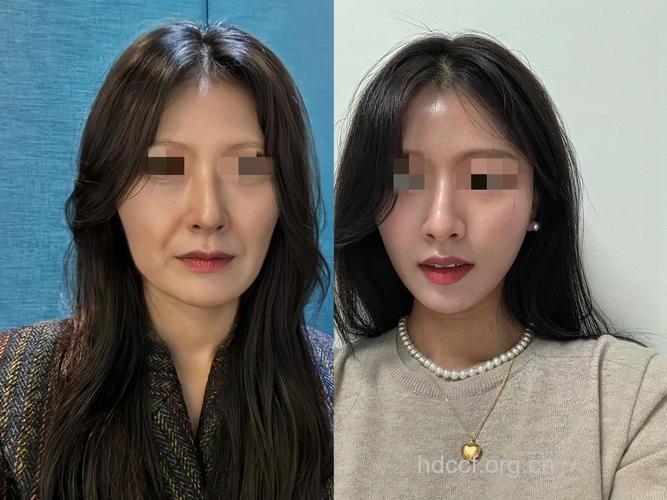 整形不只整脸 四大手术打造完美身材