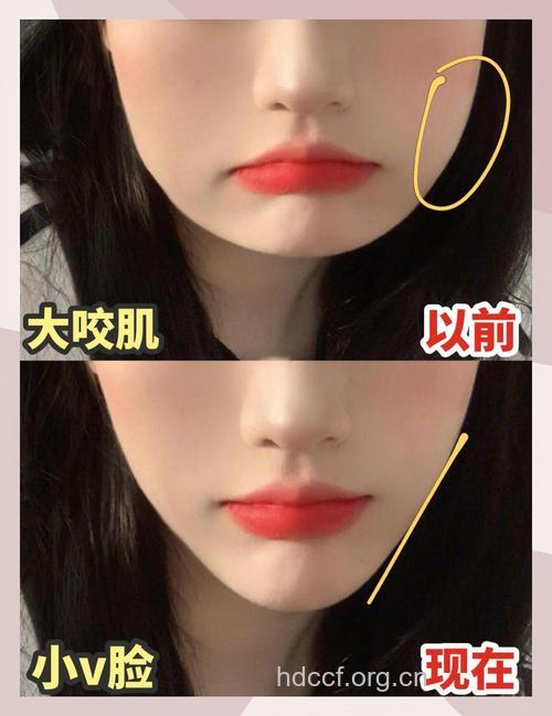 整形从瘦脸开始 轻松变成巴掌脸