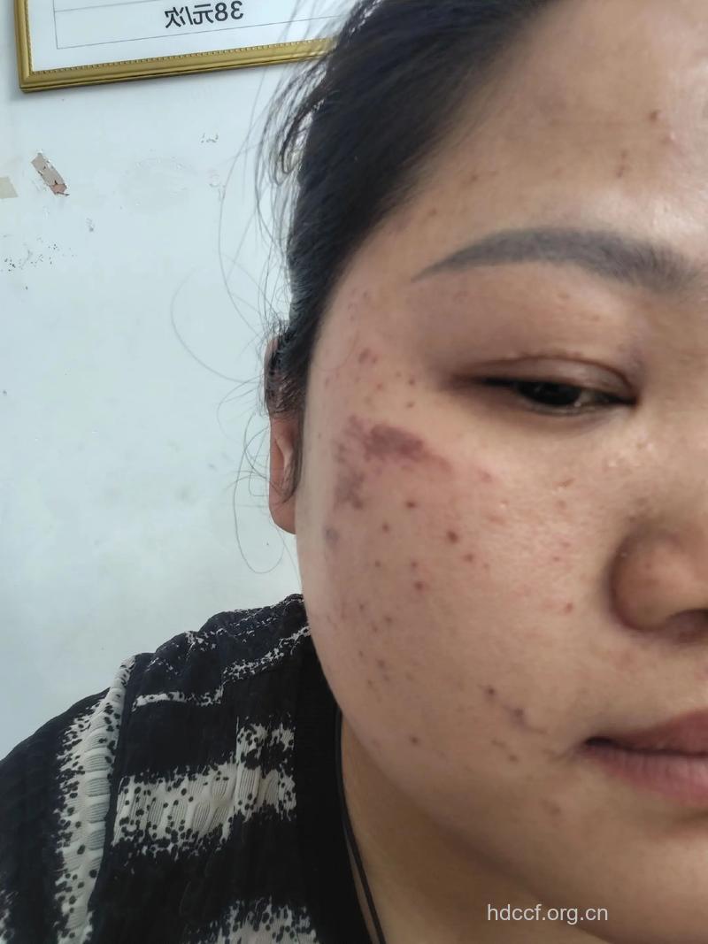 大学生祛斑后脑出血死亡 和祛斑有关系吗
