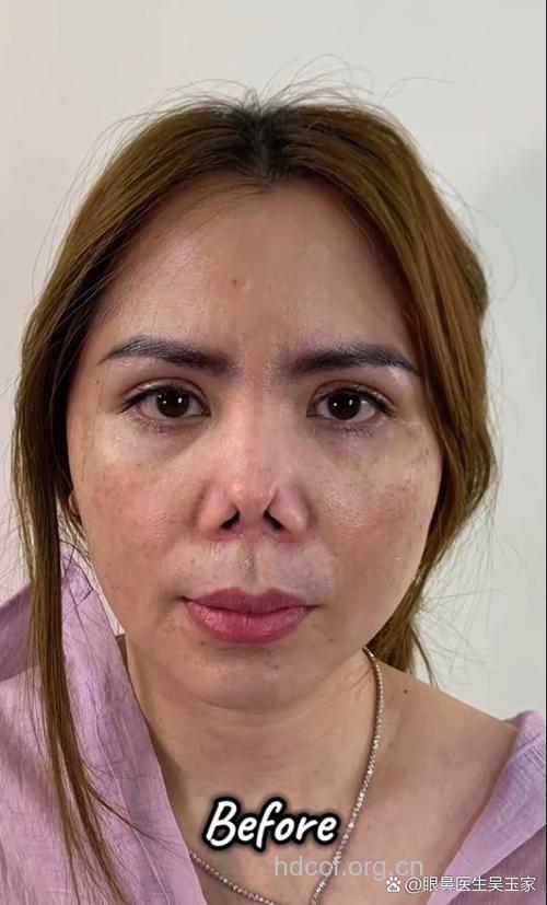 整形要慎重 胡乱整容易又丑又瞎